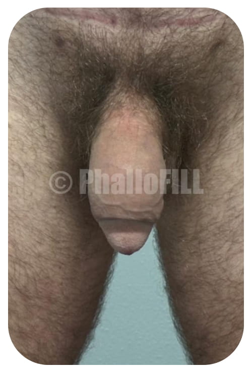 Before and After (TY) PhalloFILL® enhancement five point twenty five Inch circumference flaccid Before
