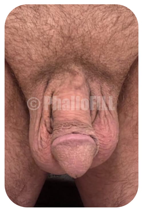 Before and After (TY) PhalloFILL® enhancement Inch circumference flaccid Before