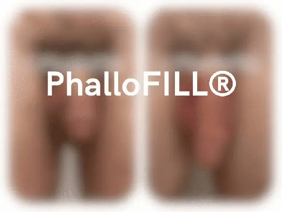 Veintiún unidades de mejora PhalloFILL®