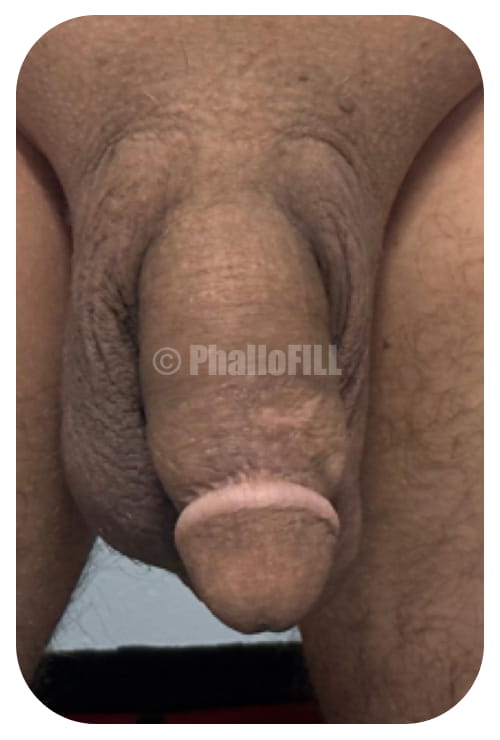 PhalloFILL® enhancement with sixteen units five Inches circumference flaccid After